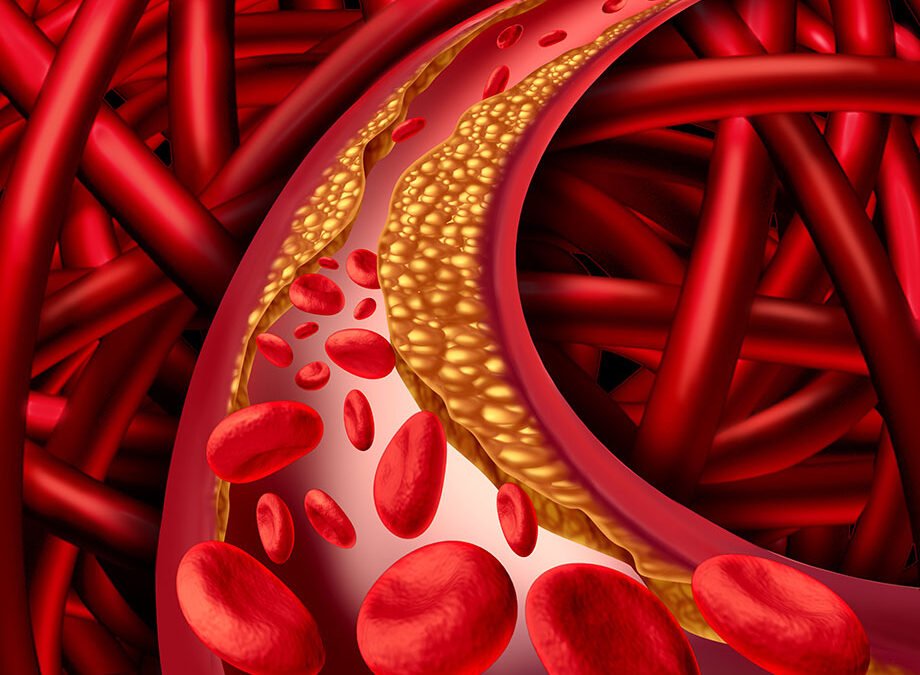 How Reducing Cholesterol Levels Can Lower Blood Pressure